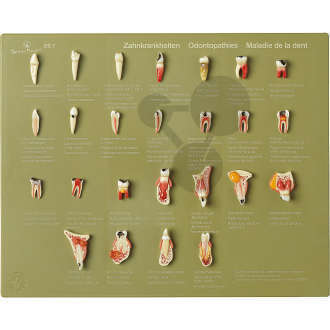 Schaukasten "Zahnkrankheiten" SOMSO®-Modell
